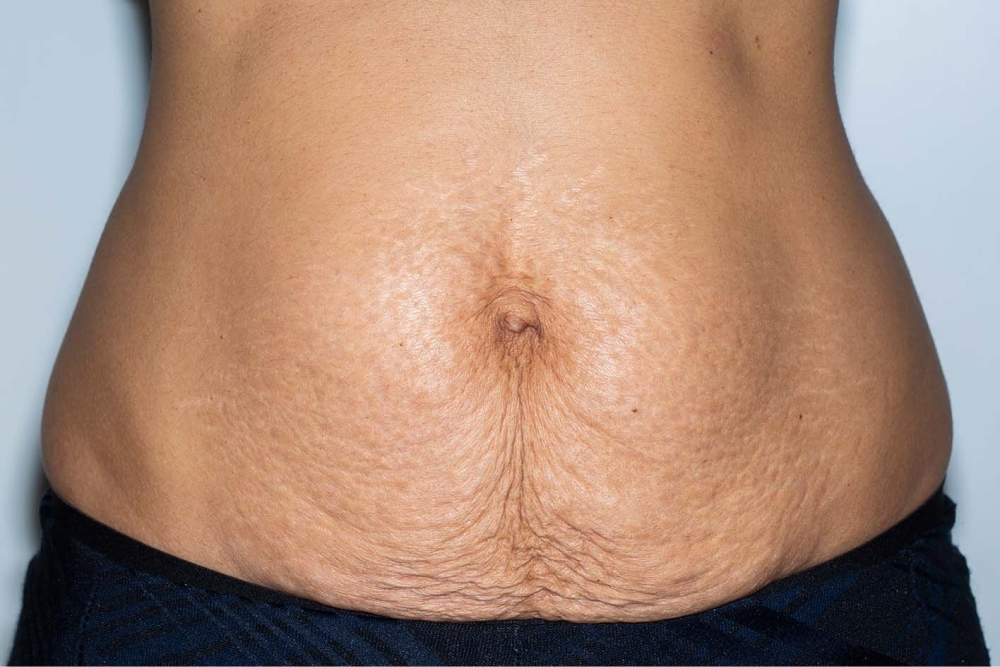 Close-up of a person's tummy showing a number of creases in the skin under their belly button. Shown on light brown skin.